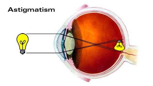 astigmatism.jpg