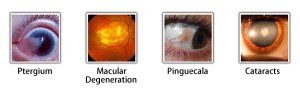 eye diseases from UV